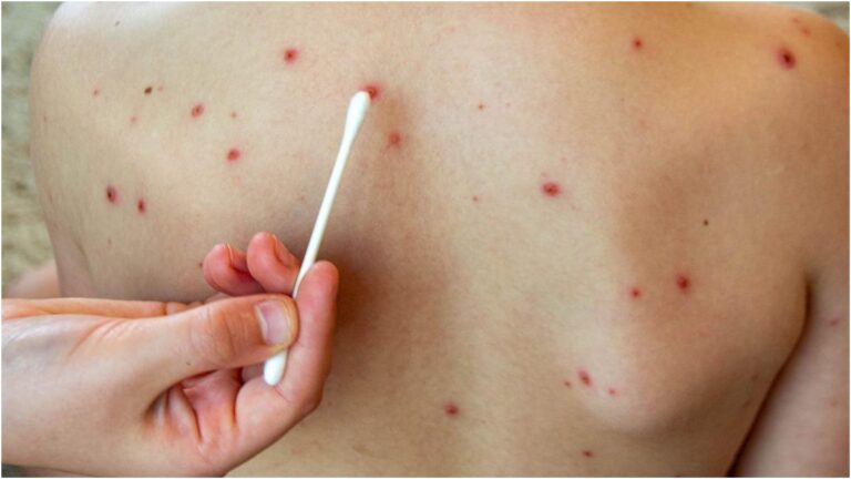 Sanidad conferma tre casi di morbillo e uno sotto osservazione a La Palma