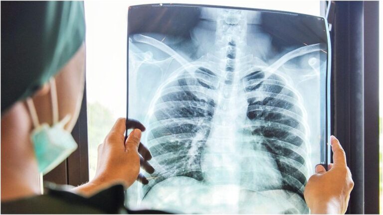 Canarie, cancro al polmone: 1.500 casi l’anno, screening TAC può ridurre la mortalità fino al 20%
